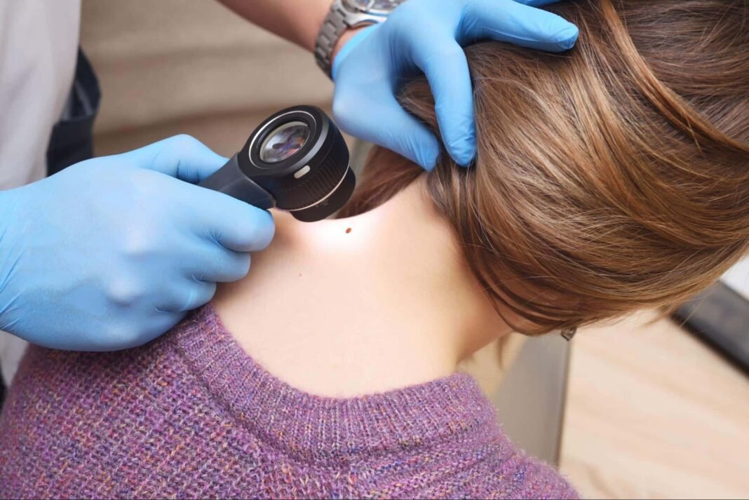 como quitar verrugas del cuello